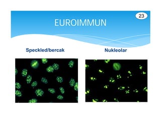 23
           EUROIMMUN

Speckled/bercak    Nukleolar
 