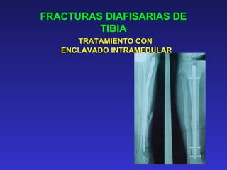 FRACTURAS DIAFISARIAS DE 
TIBIA 
TRATAMIENTO CON 
ENCLAVADO INTRAMEDULAR 
 