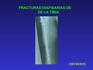 FRACTURAS DIAFISARIAS DE 
DE LA TIBIA 
ORTHOFIX 
 