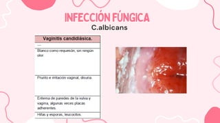 INFECCIÓNFÚNGICA
INFECCIÓNFÚNGICA
C.albicans
 