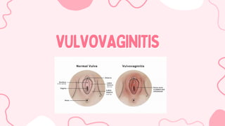 VULVOVAGINITIS
VULVOVAGINITIS
 