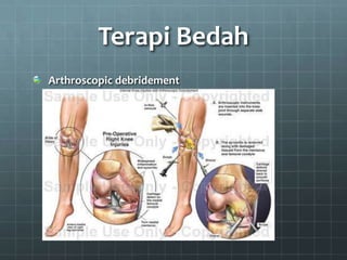 Terapi Bedah
Arthroscopic debridement
 