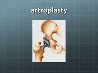 artroplasty
 