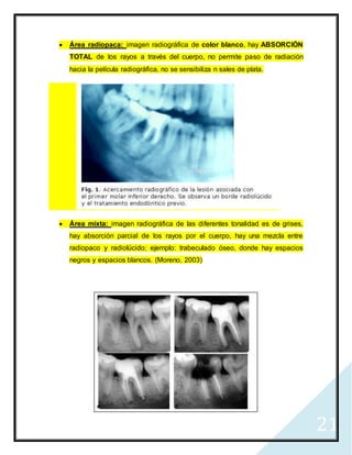 21
 Área radiopaca: imagen radiográfica de color blanco, hay ABSORCIÓN
TOTAL de los rayos a través del cuerpo, no permite paso de radiación
hacia la película radiográfica, no se sensibiliza n sales de plata.
 Área mixta: imagen radiográfica de las diferentes tonalidad es de grises,
hay absorción parcial de los rayos por el cuerpo, hay una mezcla entre
radiopaco y radiolúcido; ejemplo: trabeculado óseo, donde hay espacios
negros y espacios blancos. (Moreno, 2003)
 