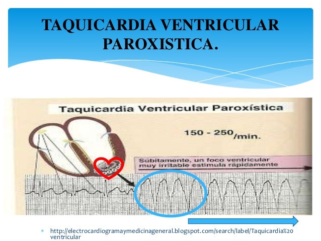 Resultado de imagen para taquicardia ventricular paroxistica