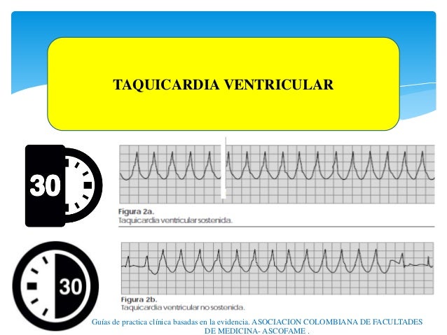 Resultado de imagen para taquicardia ventricular paroxistica
