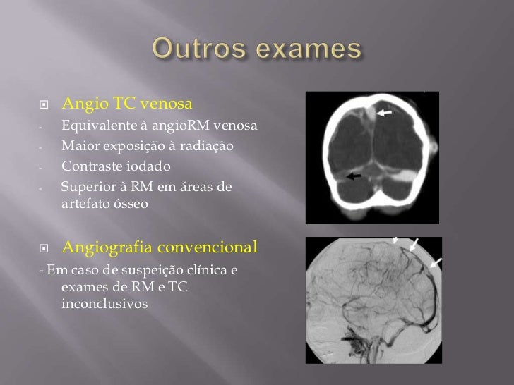Trombose Venosa cerebral Trombose Venosa cerebral