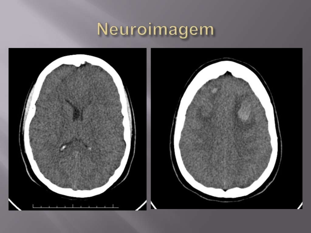 Trombose Venosa cerebral Trombose Venosa cerebral