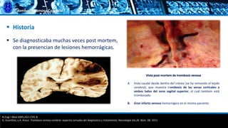 Trombosis Venosa Cerebral
 Se diagnosticaba muchas veces post mortem,
con la presencian de lesiones hemorrágicas.
 Historia
Vista post-mortem de trombosis venosa
A. Vista caudal desde dentro del cráneo (se ha removido el tejido
cerebral), que muestra trombosis de las venas corticales a
ambos lados del seno sagital superior, el cuál también está
trombosado.
B. Gran infarto venoso hemorrágico en el mismo paciente.
N Engl J Med 2005;352:1791-8
G. Guenther, y A. Arauz. Trombosis venosa cerebral: aspectos actuales del diagnóstico y tratamiento; Neurología Vol.26. Núm. 08. 2011.
 