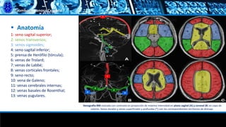 Trombosis Venosa Cerebral
1: seno sagital superior;
2: senos transversos;
3: senos sigmoides;
4: seno sagital inferior;
5: prensa de Herófilo (tórcula);
6: venas de Trolard;
7: venas de Labbé;
8: venas corticales frontales;
9: seno recto;
10: vena de Galeno;
11: venas cerebrales internas;
12: venas basales de Rosenthal;
13: venas yugulares.
 Anatomía
Venografía-RM realzada con contraste en proyección de máxima intensidad en plano sagital (A) y coronal (B) en capa de
colores. Senos durales y venas superficiales y profundas (*) con los correspondientes territorios de drenaje.
 