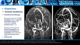 Trombosis Venosa Cerebral
 Diagnóstico.
 Variantes Anatómicas
G. Guenther, y A. Arauz. Trombosis venosa cerebral: aspectos actuales del diagnóstico y tratamiento; Neurología Vol.26. Núm. 08. 2011.
Puig J, Pedraza S, Blasco G, Serena J. Actualización en el diagnóstico neurorradiológico de la trombosis venosa cerebral. Radiología. 2009;51:351—561.
 Transverse sinus ﬂow gap.
(a) Coronal image from TOF MR
venography shows an apparent
interruption of ﬂow in the
medial part of the left
transverse sinus (arrows).
(b) Oblique MIP image from
contrast-venography shows
enhancement indicative of
normal ﬂow in the medial part
of the left transverse sinus
(arrow).
 enhanced MR
 