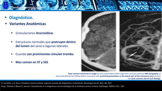 Trombosis Venosa Cerebral
 Diagnóstico.
 Variantes Anatómicas
 Granulaciones Aracnoideas
 Estructuras normales que protruyen dentro
del lumen del seno o lagunas laterales
 Cuando son prominentes simulan trombo
 Mas común en ST y SSS
G. Guenther, y A. Arauz. Trombosis venosa cerebral: aspectos actuales del diagnóstico y tratamiento; Neurología Vol.26. Núm. 08. 2011.
Puig J, Pedraza S, Blasco G, Serena J. Actualización en el diagnóstico neurorradiológico de la trombosis venosa cerebral. Radiología. 2009;51:351—561.
Axial contrast-enhanced CT image (b) and superoinferior MIP image from contrast-enhanced MR venography (c)
show well-deﬁned focal ﬁlling defects consistent with arachnoid granulations in the lateral part of the transverse sinus (arrow),
the most common site of such ﬁndings.
 