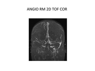ANGIO RM 2D TOF COR
 