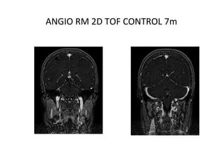 ANGIO RM 2D TOF CONTROL 7m
 