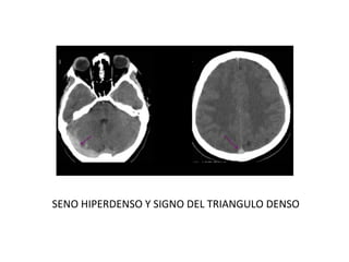 SENO HIPERDENSO Y SIGNO DEL TRIANGULO DENSO
 