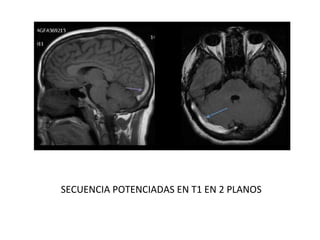 SECUENCIA POTENCIADAS EN T1 EN 2 PLANOS
 