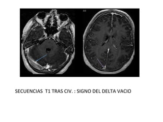 SECUENCIAS T1 TRAS CIV. : SIGNO DEL DELTA VACIO
 