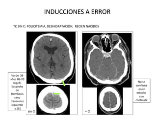 INDUCCIONES A ERROR
TC SIN C: POLICITEMIA, DESHIDRATACION, RECIEN NACIDOS
Varón 36
años Hb 20
mg/dl.
Sospecha
de
trombosis
seno
transverso
izquierdo
y SSS
No se
confirma
en el
estudio
con
contraste
+ Csin C
 