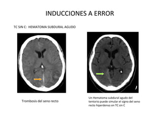 INDUCCIONES A ERROR
TC SIN C: HEMATOMA SUBDURAL AGUDO
Un Hematoma subdural agudo del
tentorio puede simular el signo del seno
recto hiperdenso en TC sin C
Trombosis del seno recto
 