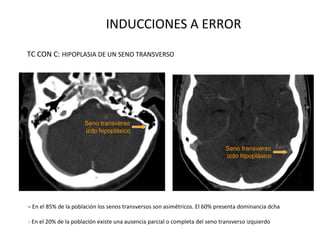 INDUCCIONES A ERROR
TC CON C: HIPOPLASIA DE UN SENO TRANSVERSO
- En el 85% de la población los senos transversos son asimétricos. El 60% presenta dominancia dcha
- En el 20% de la población existe una ausencia parcial o completa del seno transverso izquierdo
Seno transverso
izdo hipoplásico
Seno transverso
izdo hipoplásico
 