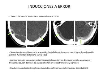 INDUCCIONES A ERROR
TC CON C: GRANULACIONES ARACNOIDEAS DE PACCIONI
- Son extensiones vellosas de la aracnoides hacia la luz de los senos y es el lugar de reabsorción
del LCR. Aumentan de tamaño con la edad
- Aunque son más frecuentes a nivel parasagital superior, las de mayor tamaño y que con >
frecuencia causan defectos de repleción están en senos transverso y sigmoide
- Producen un defecto de repleción lobulado o esférico bien delimitado de densidad LCR
 