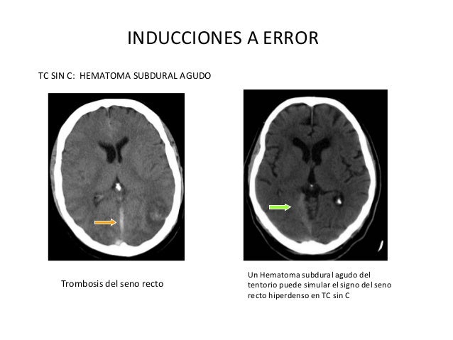 Lectura de caso: Trombosis venosa cerebral