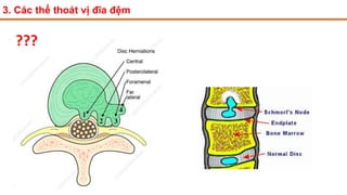 3. Các thể thoát vị đĩa đệm
???
 