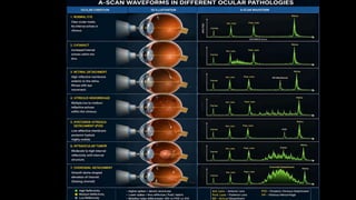 Comprehensive Overview of A-Scan Biometry in Ophthalmology | PDF