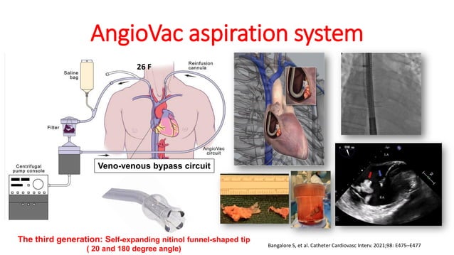 Novel management options for tricuspid endocarditis | PPT