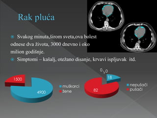  Svakog minuta,širom sveta,ova bolest
odnese dva života, 3000 dnevno i oko
milion godišnje.
 Simptomi – kašalj, otežano disanje, krvavi ispljuvak itd.
4900
1500
muškarci
žene
18
82
0 0
nepušači
pušači
 