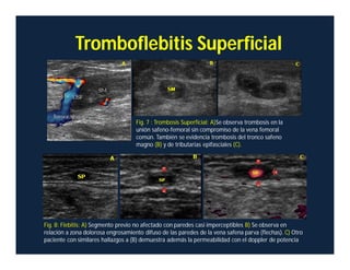 Tromboflebitis Superficial
Fig. 8: Flebitis: A) Segmento previo no afectado con paredes casi imperceptibles B) Se observa en
relación a zona dolorosa engrosamiento difuso de las paredes de la vena safena parva (flechas). C) Otro
paciente con similares hallazgos a (B) demuestra además la permeabilidad con el doppler de potencia
Fig. 7 : Trombosis Superficial: A)Se observa trombosis en la
unión safeno-femoral sin compromiso de la vena femoral
común. También se evidencia trombosis del tronco safeno
magno (B) y de tributarias epifasciales (C).
 