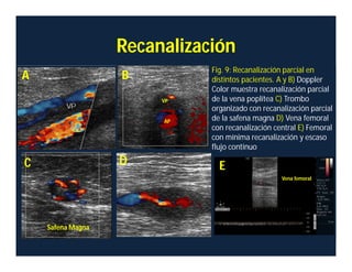 A B
C D E
Recanalización
Fig. 9: Recanalización parcial en
distintos pacientes. A y B) Doppler
Color muestra recanalización parcial
de la vena poplítea C) Trombo
organizado con recanalización parcial
de la safena magna D) Vena femoral
con recanalización central E) Femoral
con mínima recanalización y escaso
flujo continuo
Vena femoral
Safena Magna
VP
AP
 