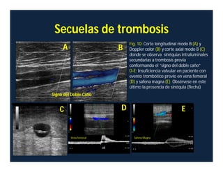 Secuelas de trombosis
Fig. 10: Corte longitudinal modo B (A) y
Doppler color (B) y corte axial modo B (C)
donde se observa sinéquias intraluminales
secundarias a trombosis previa
conformando el “signo del doble caño”
D-E: Insuficiencia valvular en paciente con
evento trombótico previo en vena femoral
(D) y safena magna (E). Obsérvese en este
último la presencia de sinéquia (flecha)
A B
C D E
Vena femoral Safena Magna
Signo del Doble Caño
 