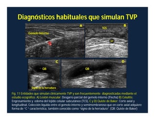 Diagnósticos habituales que simulan TVP
Gemelo Interno
TCS
QB QB
Fig. 11 Entidades que simulan clínicamente TVP y son frecuentemente diagnosticadas mediante el
estudio ecográfico. A) Lesión muscular: Desgarro parcial del gemelo interno (Flecha) B) Celulitis:
Engrosamiento y edema del tejido celular subcutáneo (TCS), C y D) Quiste de Baker: Corte axial y
longitudinal, Colección líquida entre el gemelo interno y semimembranoso que en corte axial adquiere
forma de “C “ característica, también conocido como “signo de la herradura”. (QB: Quiste de Baker)
Signo de la herradura
 