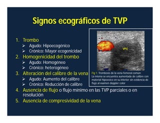 Signos ecográficos de TVP
1. Trombo
 Agudo: Hipoecogénico
 Crónico: Mayor ecogenicidad
2. Homogenicidad del trombo
 Agudo: Homogéneo
 Crónico: heterogéneo
3. Alteración del calibre de la vena
 Agudo: Aumento del calibre
 Crónico: Reducción de calibre
4. Ausencia de flujo o flujo mínimo en las TVP parciales o en
resolución
5. Ausencia de compresividad de la vena
Fig 1: Trombosis de la vena femoral común:
La misma se encuentra aumentada de calibre con
material hipoeoico en su interior sin evidencia de
flujo al examen doppler color
 