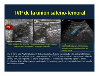 Es de buena práctica ante un paciente con
trombosis femoral evaluar con la extensión
anatómica de dicha trombosis mas allá del
miembro inferior.
Fig. 3: Corte axial A) y longitudinal B) de la unión safeno-femoral trombosada. Este corte anatómico es
un punto de referencia útil para comenzar el estudio de TVP. Nótese el marcado aumento de calibre de
la vena (VFC) con respecto a la arteria (AFC) debido a la presencia de un trombo agudo. C). Corte
longitudinal de vena iliaca externa con traductor convexo que muestra la extensión la trombosis mas allá
del miembro inferior
TVP de la unión safeno-femoral
A B C
El corte anatómico axial de la unión safeno-femoral conforma el signo ecográfico
conocido como “Mickey Mouse”, en este caso trombosado.
Signo de Mickey Mouse
 