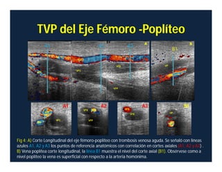 TVP del Eje Fémoro -Poplíteo
A1 A2 A3
B1
Fig 4: A) Corte Longitudinal del eje fémoro-poplíteo con trombosis venosa aguda. Se señaló con líneas
azules A1, A2 y A3 los puntos de referencia anatómicos con correlación en cortes axiales (A1, A2 y A3) .
B) Vena poplítea corte longitudinal, la línea B1 muestra el nivel del corte axial (B1). Obsérvese como a
nivel poplíteo la vena es superficial con respecto a la arteria homónima.
A1 A2 A3 B1
 