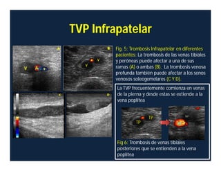 TVP Infrapatelar
Fig. 5: Trombosis Infrapatelar en diferentes
pacientes: La trombosis de las venas tíbiales
y peróneas puede afectar a una de sus
ramas (A) o ambas (B). La trombosis venosa
profunda también puede afectar a los senos
venosos soleogemelares (C Y D).
La TVP frecuentemente comienza en venas
de la pierna y desde estas se extiende a la
vena poplítea
Fig 6: Trombosis de venas tibiales
posteriores que se entienden a la vena
poplítea
TP
TP
 
