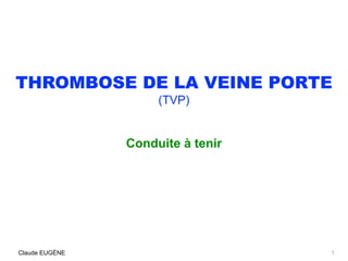 THROMBOSE DE LA VEINE PORTE
(TVP)
Conduite à tenir
Claude EUGÈNE 1
 
