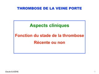 THROMBOSE DE LA VEINE PORTE
Aspects cliniques
Fonction du stade de la thrombose
Récente ou non
Claude EUGÈNE 11
 