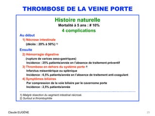THROMBOSE DE LA VEINE PORTE
Histoire naturelle
Mortalité à 5 ans : # 10%
4 complications
Au début
1) Nécrose intestinale 
...