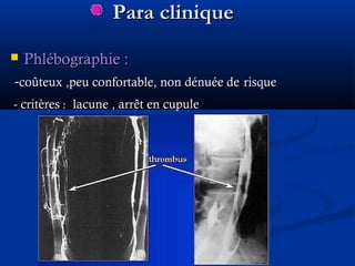Para cliniquePara clinique
 Phlébographie :Phlébographie :
--coûteux ,peu confortable, non dénuée decoûteux ,peu confortable, non dénuée de risquerisque
- critères- critères :: lacune , arrêt en cupulelacune , arrêt en cupule
 