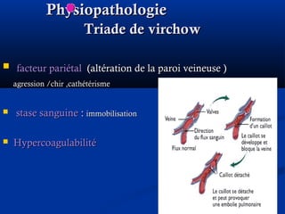 PhysiopathologiePhysiopathologie
TriadeTriade de virchowde virchow
 facteur pariétalfacteur pariétal (altération de la paroi veineuse )(altération de la paroi veineuse )
agression /chir ,cathétérismeagression /chir ,cathétérisme
 stase sanguinestase sanguine :: immobilisationimmobilisation
 HypercoagulabilitéHypercoagulabilité
 