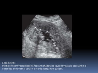 Endometritis
Multiple linear hyperechogenic foci with shadowing caused by gas are seen within a
distended endometrial canal in a febrile postpartum patient.
 