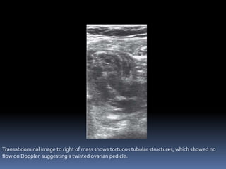Transabdominal image to right of mass shows tortuous tubular structures, which showed no
flow on Doppler, suggesting a twisted ovarian pedicle.
 