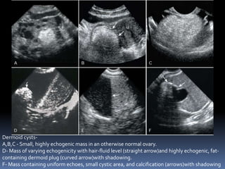 Dermoid cysts-
A,B,C - Small, highly echogenic mass in an otherwise normal ovary.
D- Mass of varying echogenicity with hair-fluid level (straight arrow)and highly echogenic, fat-
containing dermoid plug (curved arrow)with shadowing.
F- Mass containing uniform echoes, small cystic area, and calcification (arrows)with shadowing
 
