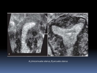 A,Unicornuate uterus; B,arcuate uterus
 