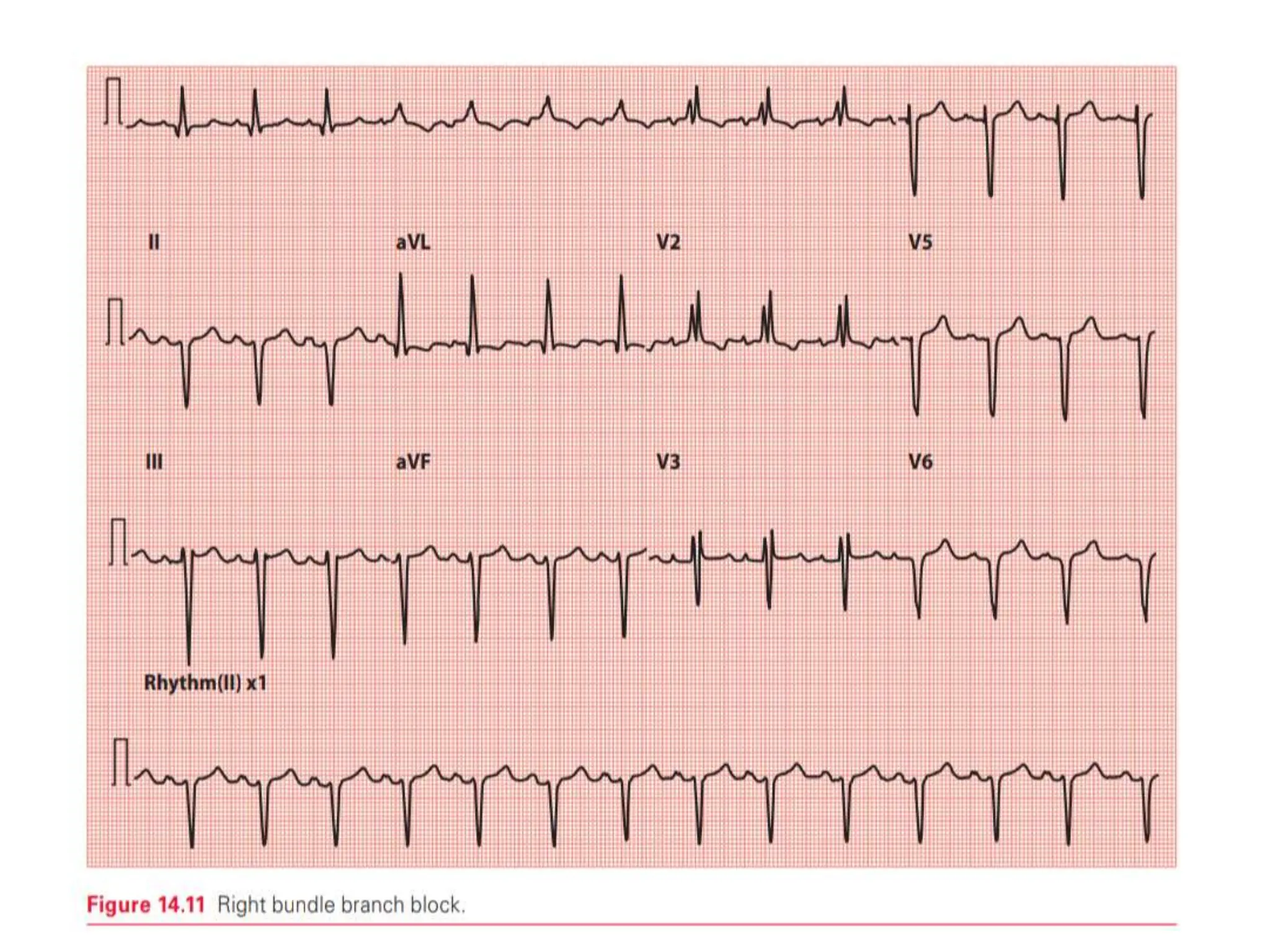 T WAVE IN ECG AND ITS ABNORMALITIES IN ECG | PPTX