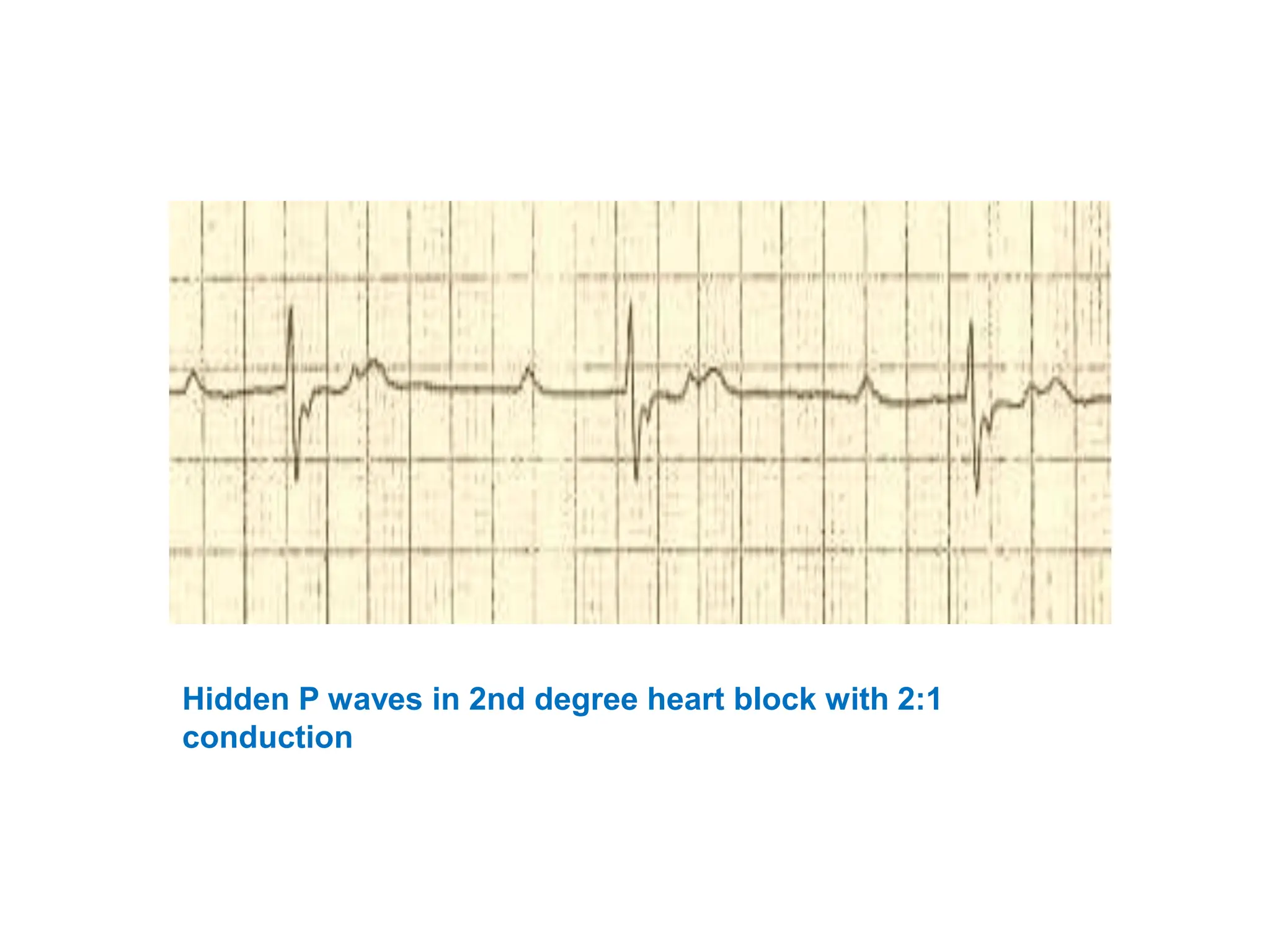 T WAVE IN ECG AND ITS ABNORMALITIES IN ECG | PPTX