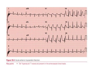 T WAVE IN ECG AND ITS ABNORMALITIES IN ECG | PPTX
